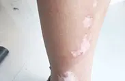 治疗图