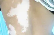治疗图